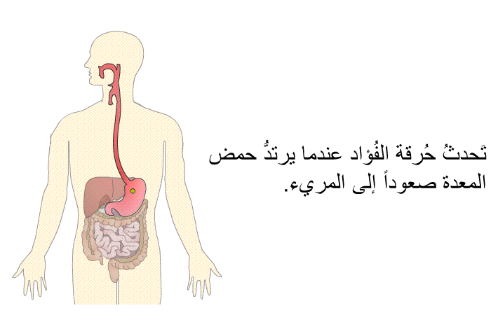 تَحدثُ حُرقة الفُؤاد عندما يرتدُّ حمض المعدة صعوداً إلى المريء.