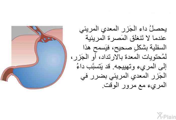 يحصلُ داء الجَزر المعدي المريئي عندما لا تَنغلق المَصرة المريئية السفلية بشكلٍ صحيح، فيَسمح هذا لمُحتويات المعدة بالارتداد، أو الجَزر، إلى المريء وتهييجه. قد يَتسبَّب داءُ الجَزر المعدي المريئي بضرر في المريء مع مرور الوقت.