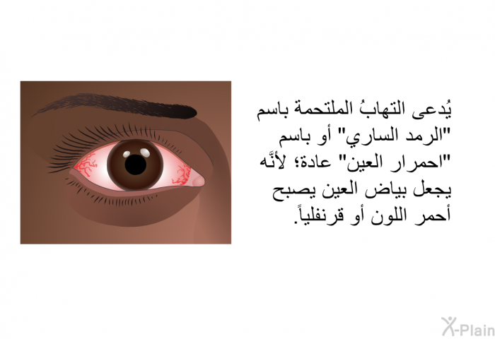 يُدعى التهابُ الملتحمة باسم "الرمد الساري" أو باسم "احمرار العين" عادة؛ لأنَّه يجعل بياض العين يصبح أحمر اللون أو قرنفلياً.