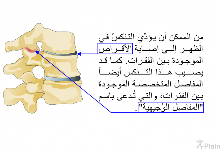 من الممكن أن يؤدِّي التنكسُ في الظهر إلى إصابة الأقراص الموجودة بين الفقرات. كما قد يصيب هذا التنكس أيضاً المفاصل المتخصصة الموجودة بين الفقرات، والتي تُدعى باسم "المفاصِل الوُجَيهية".