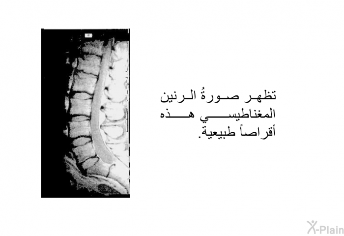 تظهر صورةُ الرنين المغناطيسي هذه أقراصاً طبيعية.