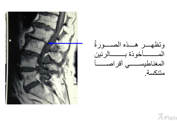 وتظهر هذه الصورةُ المأخوذة بالرنين المغناطيسي أقراصاً متنكسة.