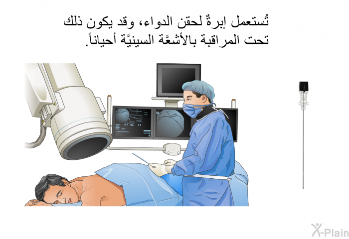 تُستعمل إبرةٌ لحقن الدواء، وقد يكون ذلك تحت المراقبة بالأشعَّة السينيَّة أحياناً.