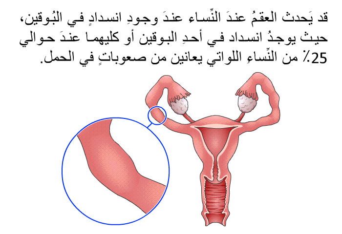 قد يَحدث العقمُ عندَ النِّساء عندَ وجودِ انسدادٍ في البُوقين، حيث يوجدُ انسدادٌ في أحدِ البوقين أو كليهما عندَ حوالي 25٪ من النِّساءِ اللواتي يعانين من صعوباتٍ في الحمل.