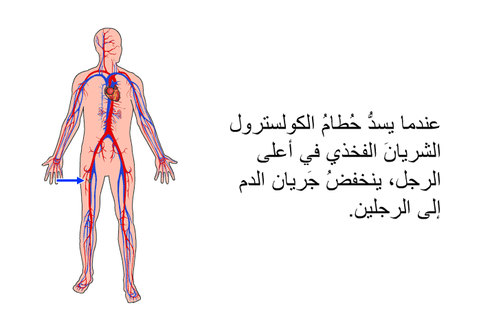 عندما يسدُّ حُطامُ الكولسترول الشريانَ الفخذي في أعلى الرجل، ينخفضُ جَريان الدم إلى الرجلين.