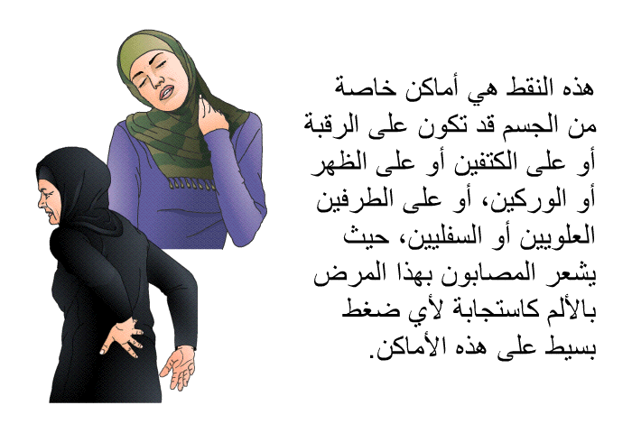 هذه النقط هي أماكن خاصة من الجسم قد تكون على الرقبة أو على الكتفين أو على الظهر أو الوركين، أو على الطرفين العلويين أو السفليين، حيث يشعر المصابون بهذا المرض بالألم كاستجابة لأي ضغط بسيط على هذه الأماكن.