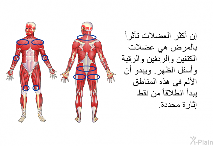 إن أكثر العضلات تأثراً بالمرض هي عضلات الكتفين والردفين والرقبة وأسفل الظهر. ويبدو أن الألم في هذه المناطق يبدأ انطلاقاً من نقط إثارة محددة.