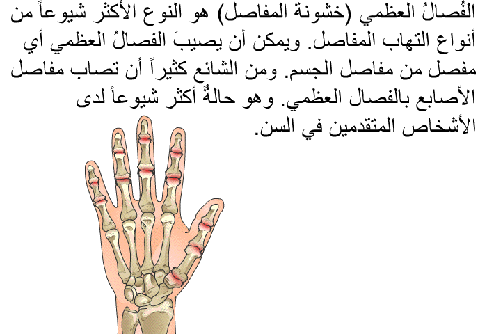 الفُصالُ العظمي (خشونة المفاصل) هو النوع الأكثر شيوعاً من أنواع التهاب المفاصل. ويمكن أن يصيبَ الفصالُ العظمي أي مفصل من مفاصل الجسم. ومن الشائع كثيراً أن تصاب مفاصل الأصابع بالفصال العظمي. وهو حالةٌ أكثر شيوعاً لدى الأشخاص المتقدمين في السن.