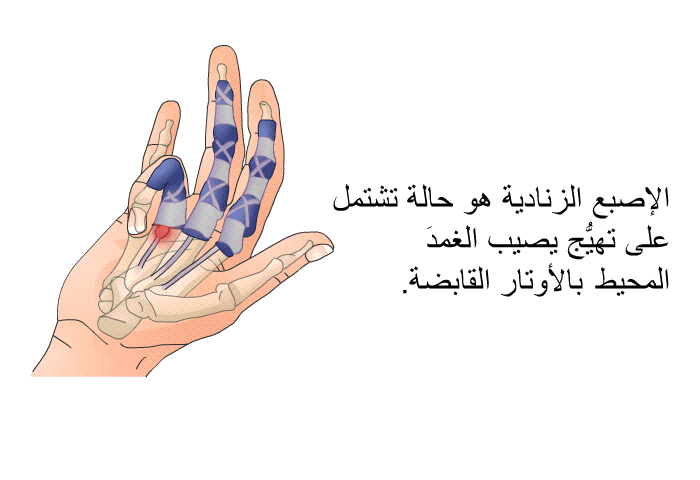 الإصبع الزنادية هو حالة تشتمل على تهيُّج يصيب الغمدَ المحيط بالأوتار القابضة.