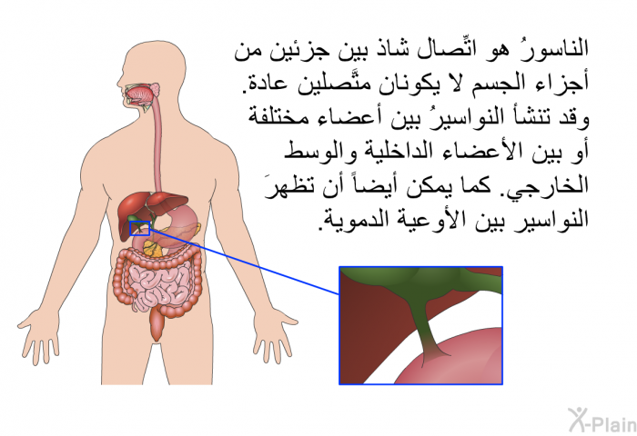 الناسورُ هو اتِّصال شاذ بين جزئين من أجزاء الجسم لا يكونان متَّصلين عادة. وقد تنشأ النواسيرُ بين أعضاء مختلفة أو بين الأعضاء الداخلية والوسط الخارجي. كما يمكن أيضاً أن تظهرَ النواسير بين الأوعية الدموية.