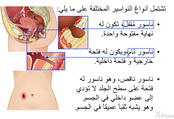 تشتمل أنواعُ النواسير المختلفة على ما يلي:   ناسور مُقفل، تكون له نهاية مفتوحة واحدة.  ناسور تام،ويكون له فتحة خارجية و فتحة داخلية.  ناسور ناقص، وهو ناسور له فتحة على سطح الجلد لا تؤدي إلى عضو داخلي في الجسم. وهو يشبه ثقباً عميقاً في الجسم.