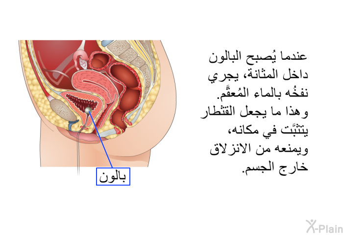 عندما يُصبح البالون داخل المثانة، يجري نفخُه بالماء المُعقَّم. وهذا ما يجعل القثطار يتثبَّت في مكانه، ويمنعه من الانزلاق خارج الجسم.