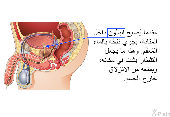 عندما يُصبح البالون داخل المثانة، يجري نفخُه بالماء المُعقَّم. وهذا ما يجعل القثطار يثبت في مكانه، ويمنعه من الانزلاق خارج الجسم.