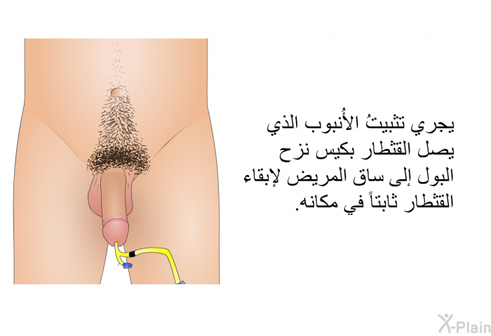 يجري تثبيتُ الأُنبوب الذي يصل القثطار بكيس نزح البول إلى ساق المريض لإبقاء القثطار ثابتاً في مكانه.