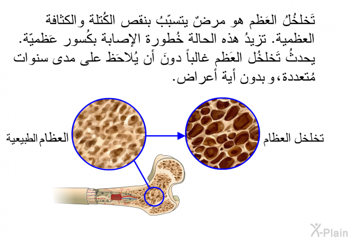 تَخلخُلُ العَظم هو مرضٌ يتسبّبُ بنقص الكُتلة والكثافة العظمية. تزيدُ هذه الحالة خُطورة الإصابة بكُسور عَظميّة. يحدثُ تَخلخُل العَظم غالباً دونَ أن يُلاحَظ على مدى سنوات مُتعددة، دون أعراض.