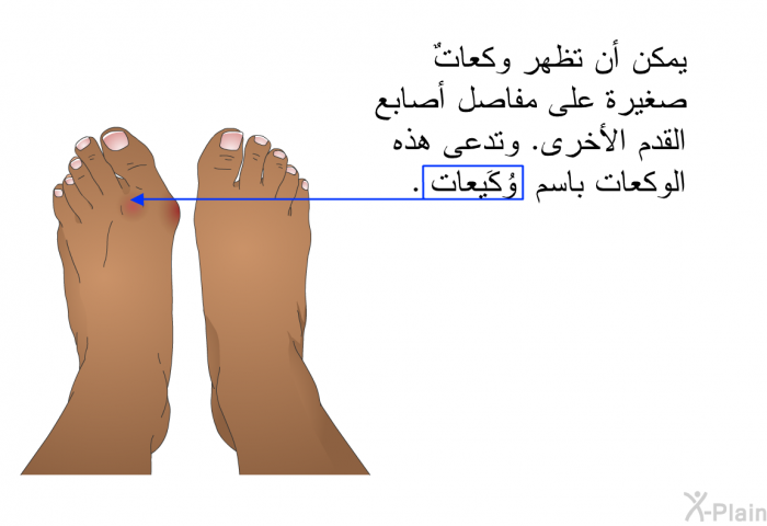 يمكن أن تظهر وكعاتٌ صغيرة على مفاصل أصابع القدم الأخرى. وتدعى هذه الوكعات باسم "وُكَيعات".