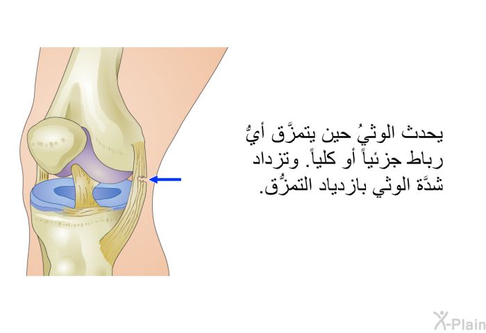 يحدث الوثيُ حين يتمزَّق أيُّ رباط جزئياً أو كلِّياً. وتزداد شدَّة الوثي بازدياد التمزُّق.