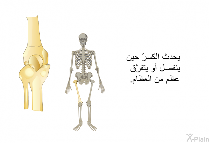 يحدث الكسرُ حين ينفصل أو يتفرَّق عظم من العظام.