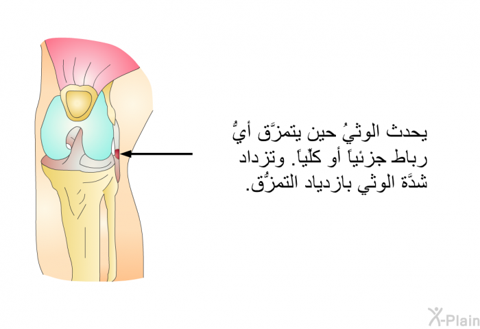 يحدث الوثيُ حين يتمزَّق أيُّ رباط جزئياً أو كلِّياً. وتزداد شدَّة الوثي بازدياد التمزُّق.