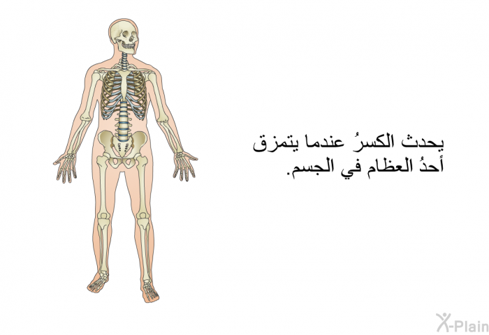 يحدث الكسرُ عندما يتمزق أحدُ العظام في الجسم.
