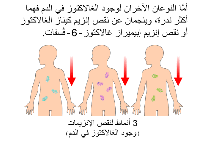 أمَّا النوعان الآخران لوجود الغالاكتوز في الدم فهما أكثر ندرة، وينجمان عن نقص إنزيم كيناز الغالاكتوز أو نقص إنزيم إبيميراز غالاكتوز-6- فُسفات.