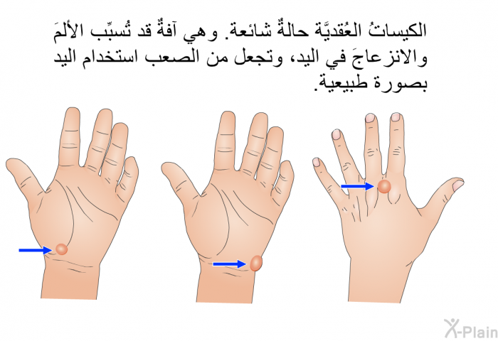 الكيساتُ العُقديَّة حالةٌ شائعة. وهي آفةٌ قد تُسبِّب الألمَ والانزعاجَ في اليد، وتجعل من الصعب استخدام اليد بصورة طبيعية.
