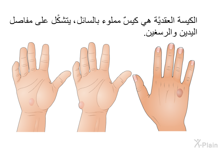 الكيسة العقديَّة هي كيسٌ مملوء بالسائل، يتشكَّل على مفاصل اليدين والرسغين.