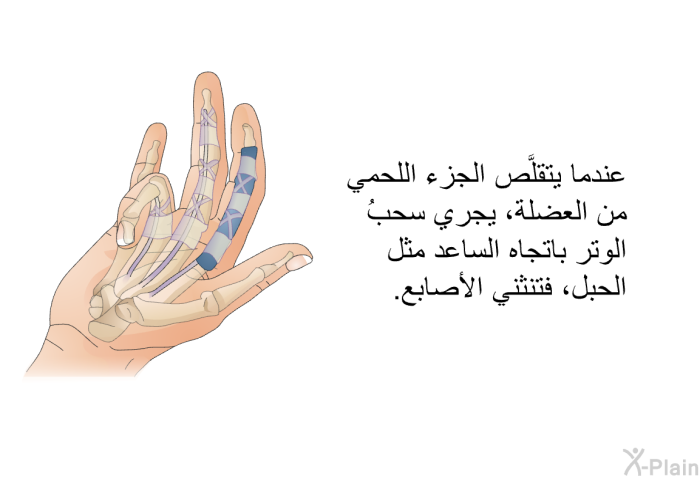 عندما يتقلَّص الجزء اللحمي من العضلة، يجري سحبُ الوتر باتجاه الساعد مثل الحبل، فتنثني الأصابع.