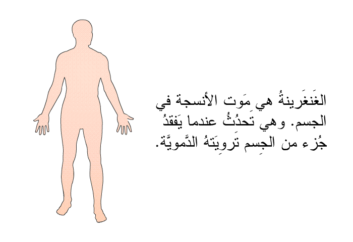 الغَنغَرينةُ هي مَوت الأنسجة في الجسم. وهي تَحدُثُ عندما يَفقدُ جُزءٌ من الجِسم تَروِيَتهُ الدَّمويَّة.