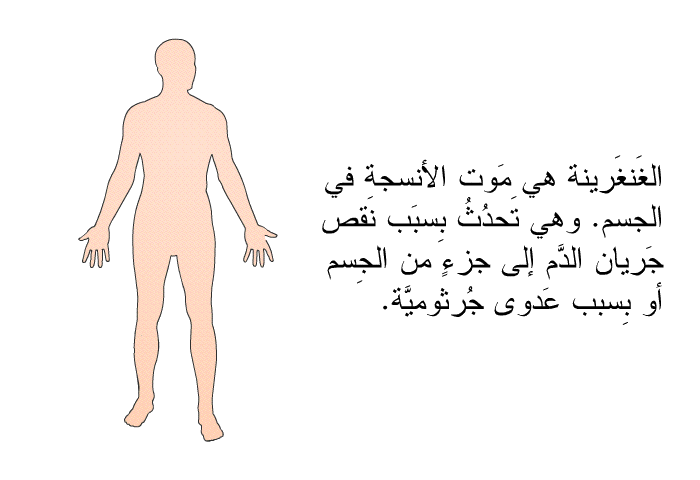 الغَنغَرينةُ هي مَوت الأنسجة في الجسم. وهي تَحدُثُ بِسبَب نَقص جَريان الدَّم إلى جزءٍ من الجِسم أو بِسبب عَدوى جُرثوميَّة.