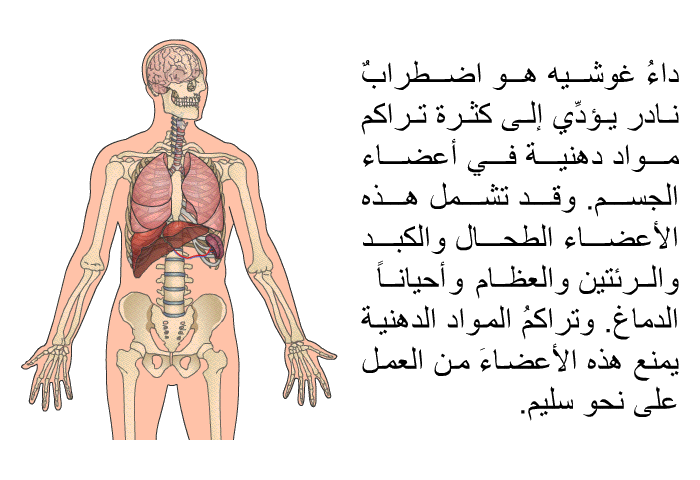 داءُ غوشيه هو اضطرابٌ نادر يؤدِّي إلى كثرة تراكم مواد دهنية في أعضاء الجسم. وقد تشمل هذه الأعضاء الطحالُ والكبد والرئتين والعظام، و أحياناً الدماغ. وتراكمُ المواد الدهنية يمنع هذه الأعضاءَ من العمل على نحو سليم.
