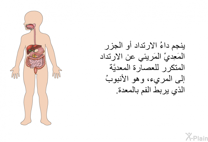 ينجم داءُ الارتداد أو الجزر المَعِديِّ المَريئي عن الارتداد المتكرر للعصارة المعديَّة إإلى المريء، وهو الأنبوبُ الذي يربط الفم بالمعدة.