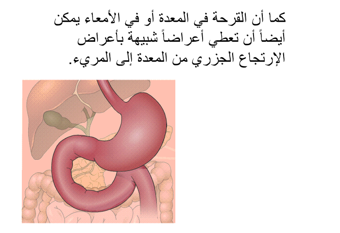 كما أن القرحة في المعدة أو في الأمعاء يمكن أيضاً أن تعطي أعراضاً شبيهة بأعراض الإرتجاع الجزري من المعدة إلى المريء.