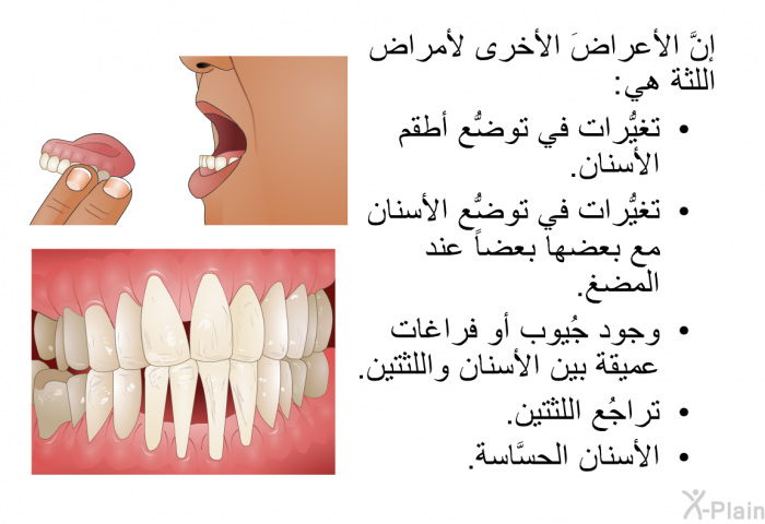 إنَّ الأعراضَ الأخرى لأمراض اللثة هي:  تغيُّرات في توضُّع أطقم الأسنان. تغيُّرات في توضُّع الأسنان مع بعضها بعضاً عند المضغ. وجود جُيوب أو فراغات عميقة بين الأسنان واللثتين. تراجُع اللثتين. الأسنان الحسَّاسة.