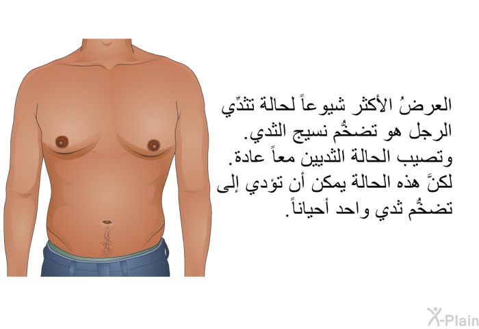 العرضُ الأكثر شيوعاً لحالة تثدِّي الرجل هو تضخُّم نسيج الثدي. وتصيب الحالةُ الثديين معاً عادة. لكنَّ هذه الحالةَ يمكن أن تؤدي إلى تضخُّم ثدي واحد أحياناً.