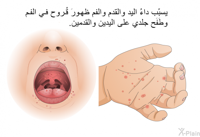 يسبِّب داءُ اليد والقدم والفم ظهورَ قُروح في الفم وطَفَح جلدي على اليدين والقدمين.