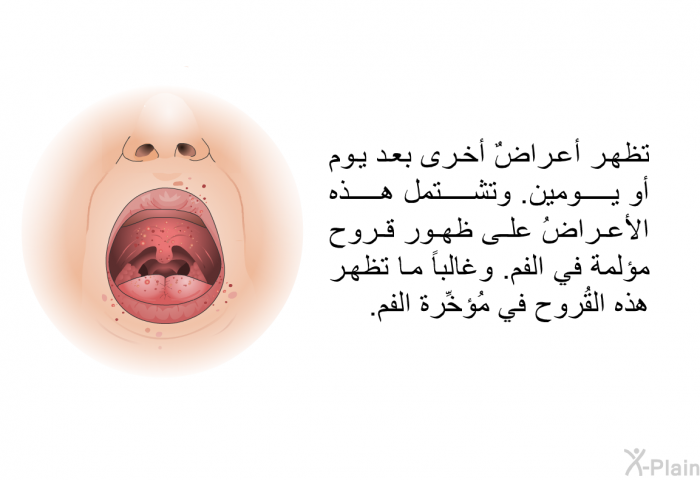 تظهر أعراضٌ أخرى بعد يوم أو يومين. وتشتمل هذه الأعراضُ على ظهور قروح مؤلمة في الفم. وغالباً ما تظهر هذه القُروح في مُؤخِّرة الفم.