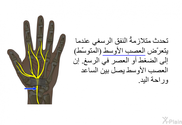 تحدث متلازمةُ النفق الرسغي عندما يتعرَّض العصب الأوسط (المتوسِّط) إلى الضغط أو العصر في الرسغ. إن العصب الأوسط يصل بين الساعد وراحة اليد.