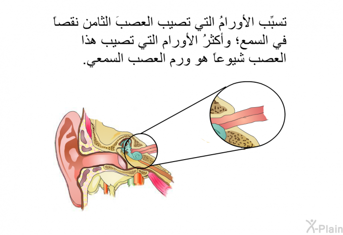 تسبِّب الأورامُ التي تصيب العصبَ الثامن نقصاً في السمع؛ وأكثرُ الأورام التي تصيب هذا العصب شيوعاً هو ورم العصب السمعي.