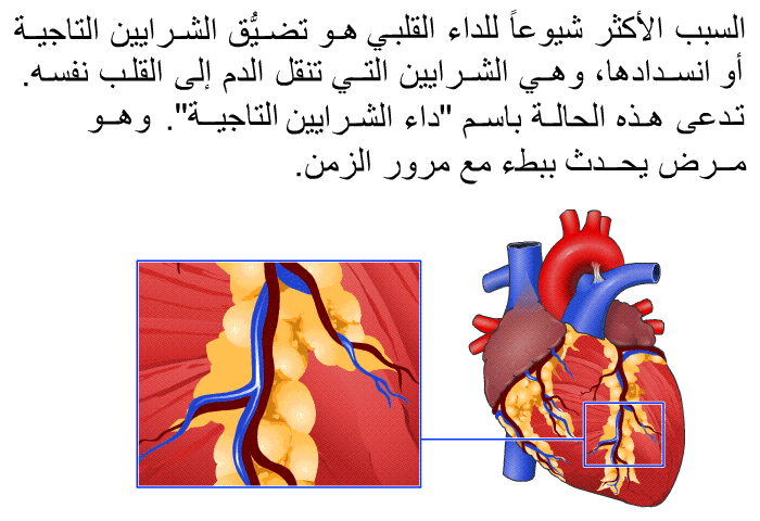 السبب الأكثر شيوعاً للداء القلبي هو تضيُّق الشرايين التاجية أو انسدادها، وهي الشرايين التي تنقل الدم إلى القلب نفسه. تدعى هذه الحالة باسم "داء الشرايين التاجية". وهو مرضٌ يحدث ببطء مع مرور الزمن.
