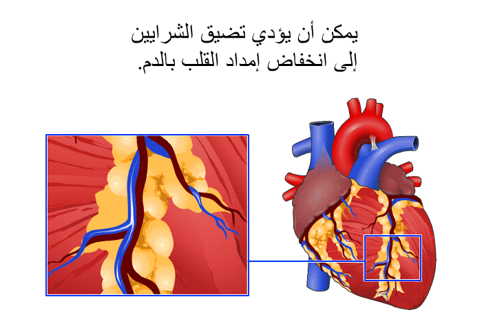 يمكن أن يؤدي تضيق الشرايين إلى انخفاض إمداد القلب بالدم.