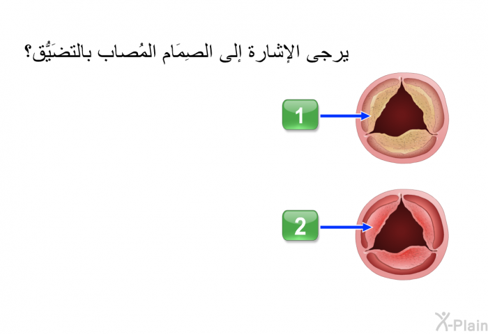 يرجى الإشارة إلى الصِمَام المُصاب بالتضَيُّق؟