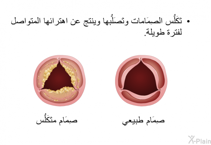 تَكَلُّس الصِمَامات وتَصَلُّبها وينتج عن اهترائها المتواصل لفترة طويلة.