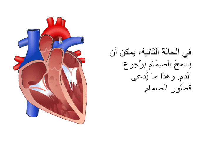 في الحالة الثانية، يمكن أن يسمحَ الصِمَام برُجوع الدم. وهذا ما يُدعى قُصُور الصمام.