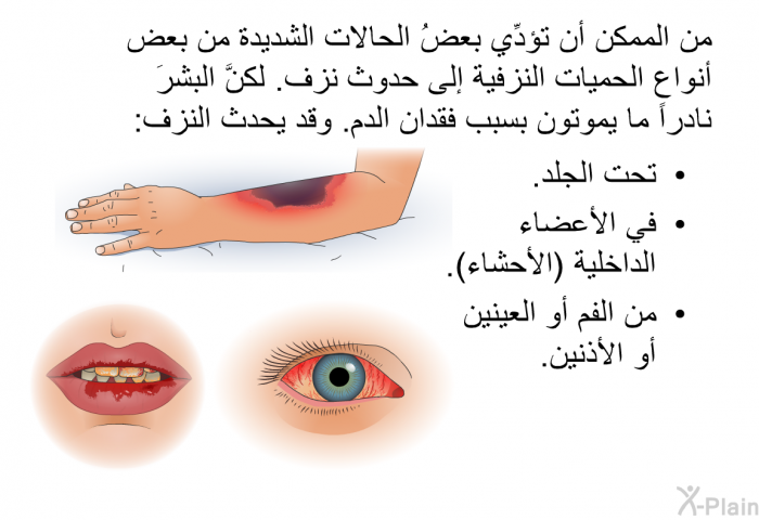 من الممكن أن تؤدِّي بعضُ الحالات الشديدة من بعض أنواع الحميات النزفية إلى حدوث نزف. لكنَّ البشرَ نادراً ما يموتون بسبب فقدان الدم. وقد يحدث النزف:  تحت الجلد. في الأعضاء الداخلية (الأحشاء). من الفم أو العينين أو الأذنين.