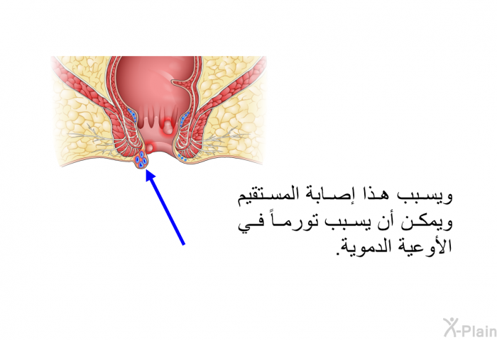 ويسبب هذا إصابة المستقيم ويمكن أن يسبب تورماً في الأوعية الدموية.