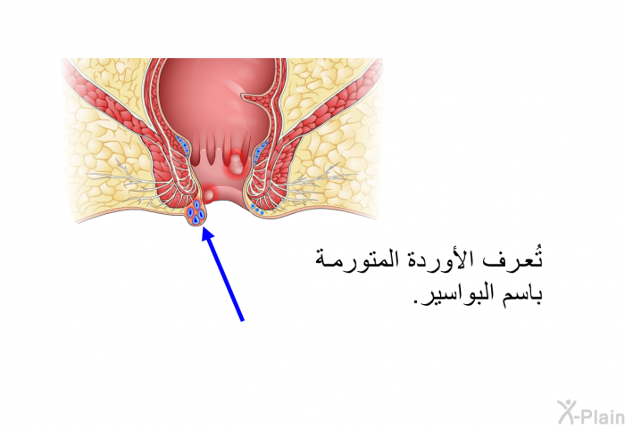 تُعرف الأوردة المتورمة باسم البواسير.