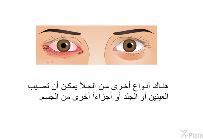 هناك أنواع أخرى من الحلأ يمكن أن تصيب العينين أو الجلد أو أجزاءاً أخرى من الجسم.