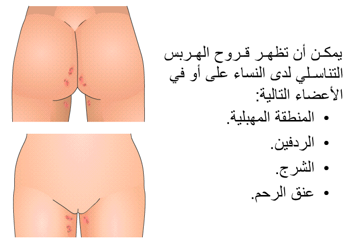يمكن أن تظهر قروح الهربس التناسلي لدى النساء على أو في الأعضاء التالية:   المنطقة المهبلية.  الردفين.  الشرج. عنق الرحم.