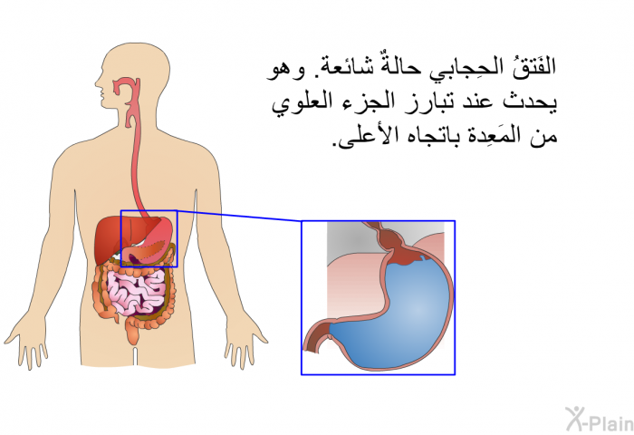 الفَتقُ الحِجابي حالةٌ شائعة. وهو يحدث عند تبارز الجزء العلوي من المَعِدة باتجاه الأعلى.